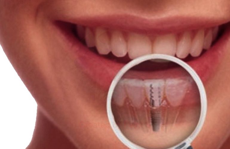 imagen de implantes dentales clinica moratalaz 66