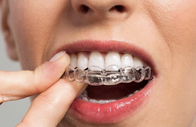 imagen de ortodoncia invisible invisalign madrid