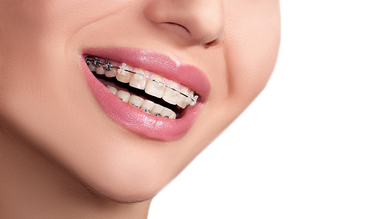 imagen de brackets madrid