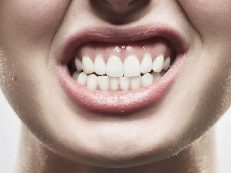 imagen de bruxismo-medicina-facial-clinica-doctor-omid