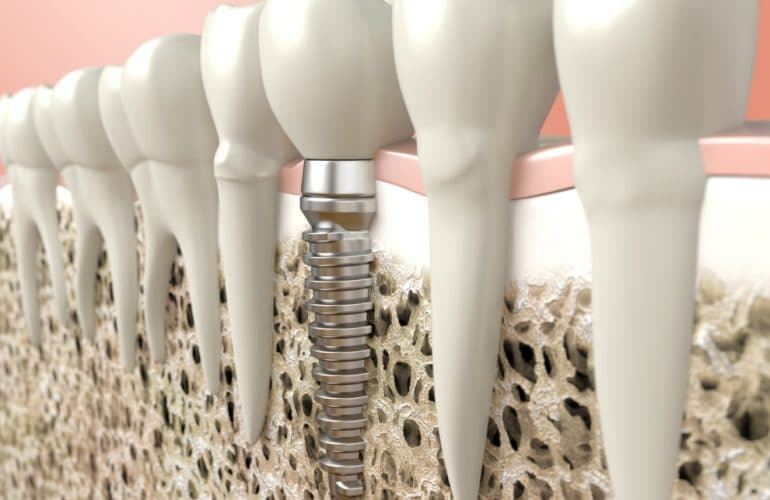 implantes carga inmediata