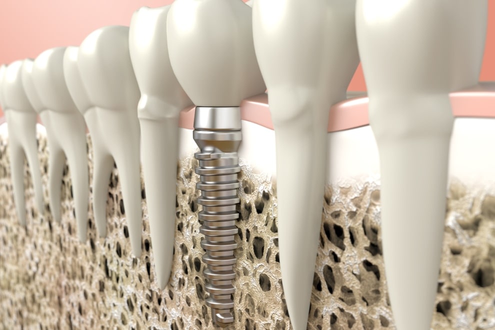 implantes carga inmediata